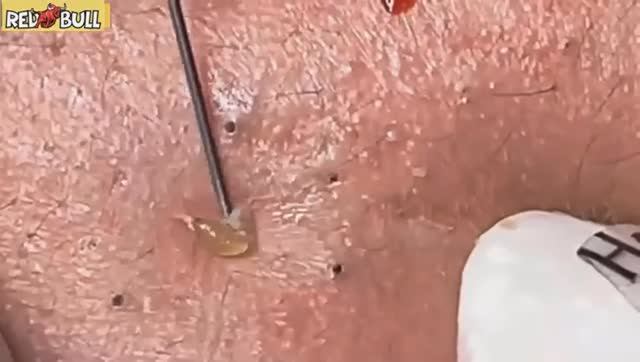 Прыщ, который заставил меня ахнуть. Самый необычный случай.𝟗𝟎𝟎𝟑𝟖𝟗 смотреть онлайн