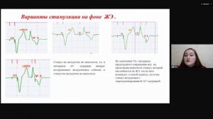 Оценка функционирования искусственного водителя ритма при анализе холтеровского мониторирования