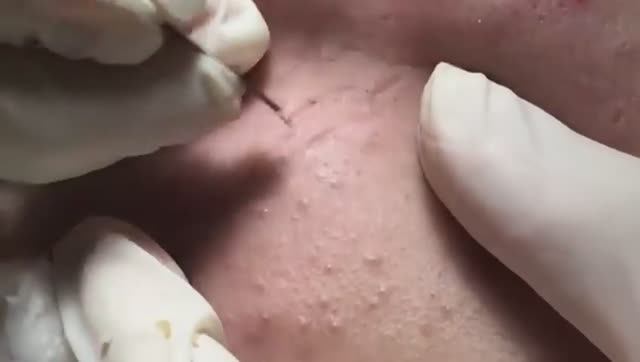 Лечение подкожных прыщей (угрей). #лечениеподкожныхпрыщей #подкожныеугри смотреть онлайн