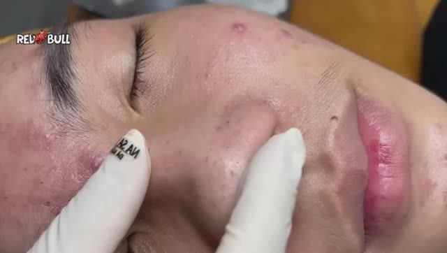 Выдавливание черных точек. Новое видео для расслабления. 𝟗𝟎𝟎𝟑𝟖 #черныеточки #чисткалица смотреть онлайн