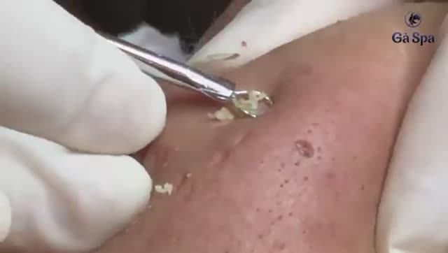 Черные точки и акне на лице: как избавиться, выдавливание черных точек. смотреть онлайн