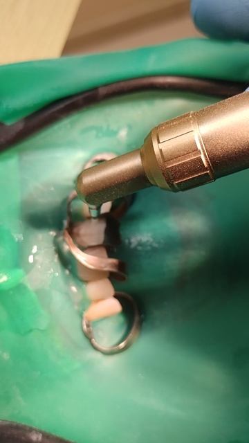 Абразивная отработка поверхности зуба 21 оксидом алюминия 30 мкм.#абразивнаяоьработказуба