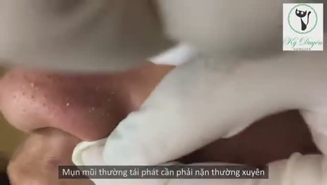 Лечение твердых желтых сальных пробок (милиумов/комедонов) на носу смотреть онлайн