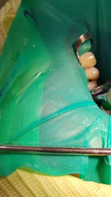 Абразивная отработка поверхности 14 зуба оксидом алюминия 30 мкм. #abrasiveblastingtooth