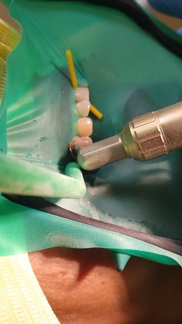 Абразивная отработка поверхности(5 класс).#абразивнаяобработкаповерхностизуба