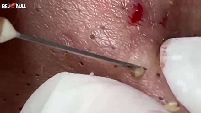 Выдавливание угрей. Расслабляющий видеоролик . 𝟗𝟎𝟎𝟑𝟗𝟎 #прыщи #угри #угреваясыпь смотреть онлайн