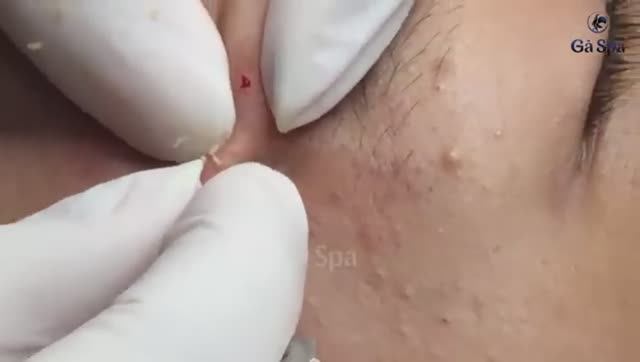 Удаление черных точек: новинка — Часть 1 смотреть онлайн