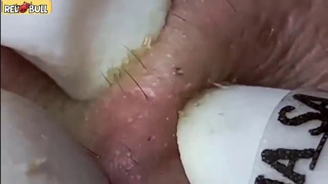 Удаление черных точек. асмр прыщи. Для расслабления. 𝟗𝟎𝟎𝟑𝟖𝟕 #черныеточки #чисткалица смотреть онлайн