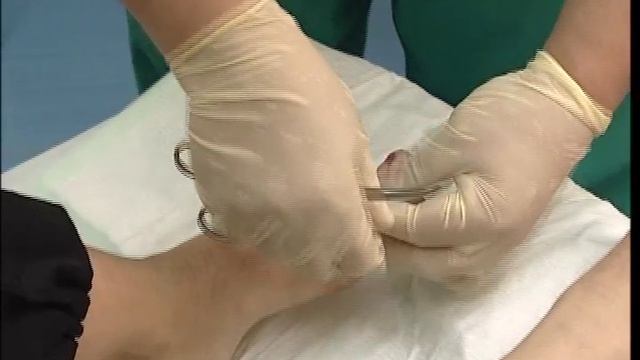 Вросший ноготь