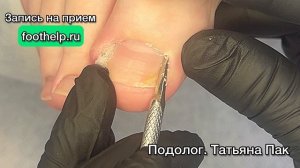 Вросший ноготь