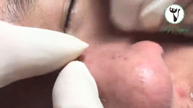 Лечение застарелых (зрелых) угрей на носу. #застарелыеугри #черныеточки #прыщинаносу смотреть онлайн