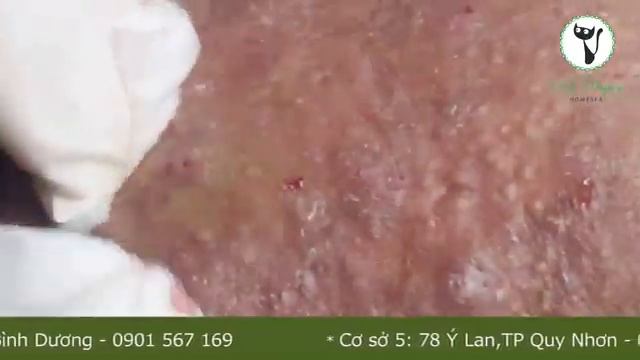 Уникальный случай лечения акне, который стоит посмотреть #тяжелыйакне смотреть онлайн