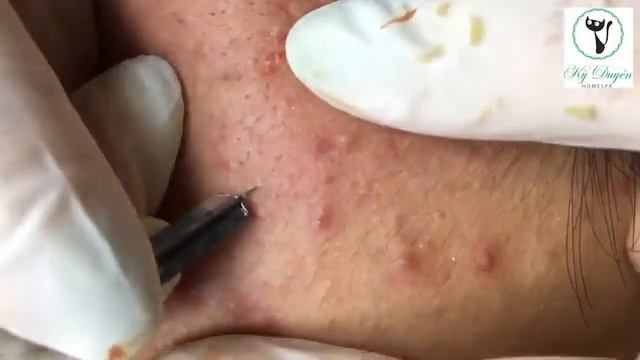 Лечение скрытых (подкожных) прыщей: опасность и непредсказуемость. смотреть онлайн