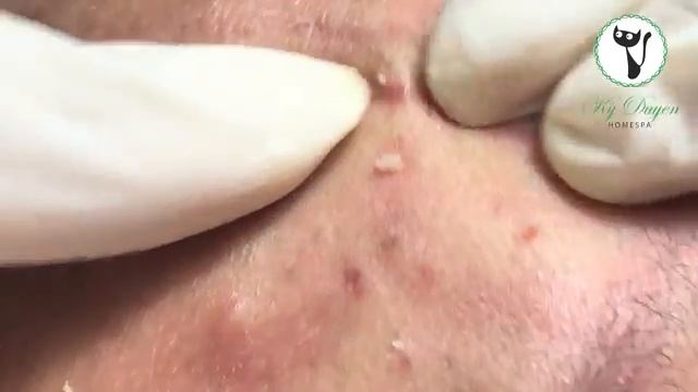 Лечение тяжелой формы черных точек. #тяжелыечерныеточки #лечениеакне смотреть онлайн