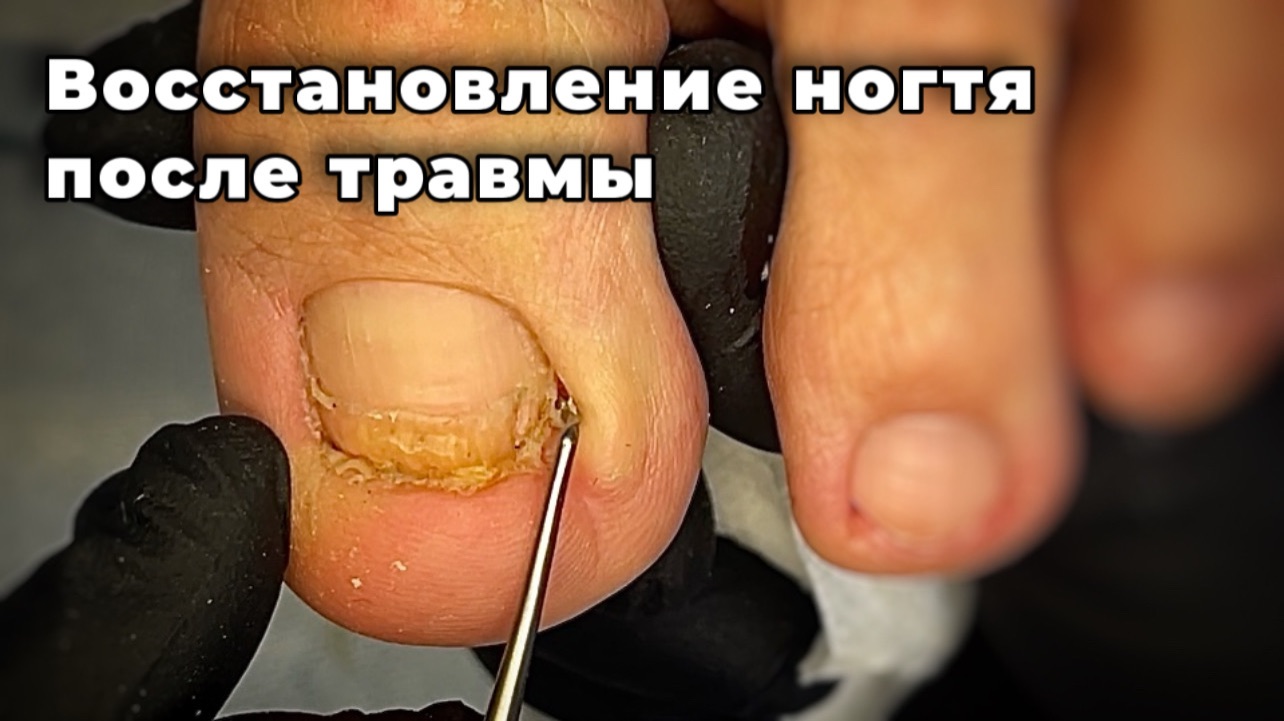 Как отрастить ноготь здоровым после травмы смотреть онлайн