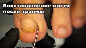 Как отрастить ноготь здоровым после травмы