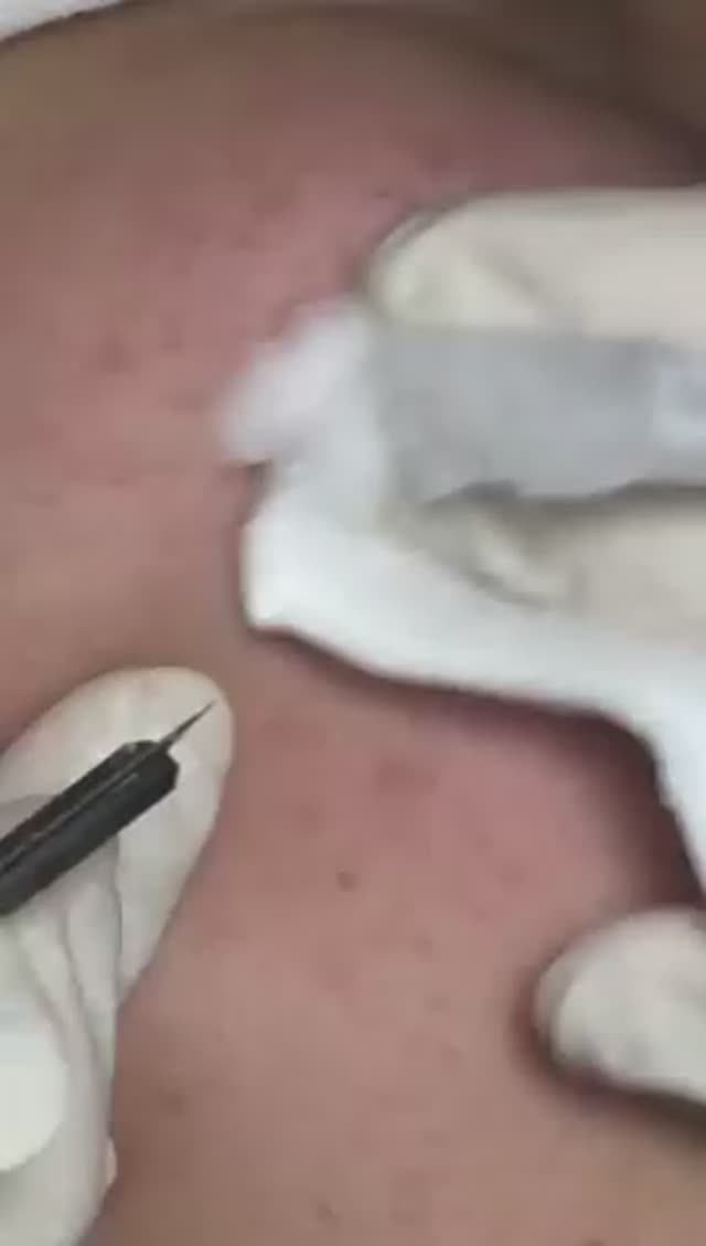 Лечение черных точек — Часть 1 #черныеточки #лечениеакне #проблемнаякожа смотреть онлайн