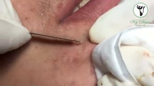 Удаление гигантского инородного образования (жировика/кисты) на кайме губы.