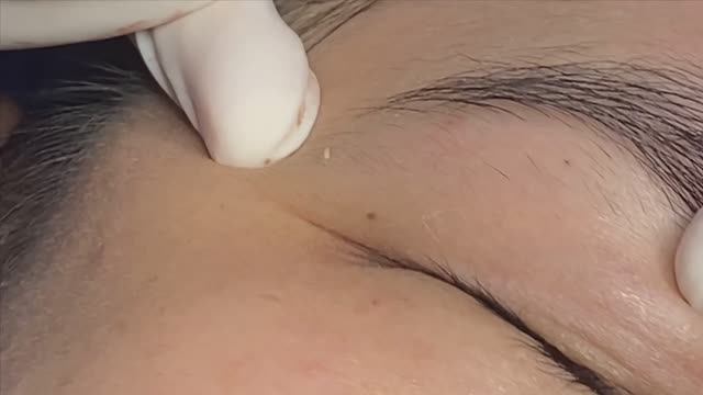 Удаление прыщей, скрытых под кожей (подкожных прыщей). #подкожныепрыщи #удалениеакне #глубокиеугри смотреть онлайн