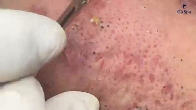 Полное видео выдавливания черных точек — Часть 1 смотреть онлайн