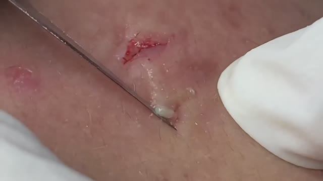 Огромные подкожные прыщи на лбу. #подкожныепрыщи #кистозныеугри #проблемнаякожа #лечениеакне смотреть онлайн