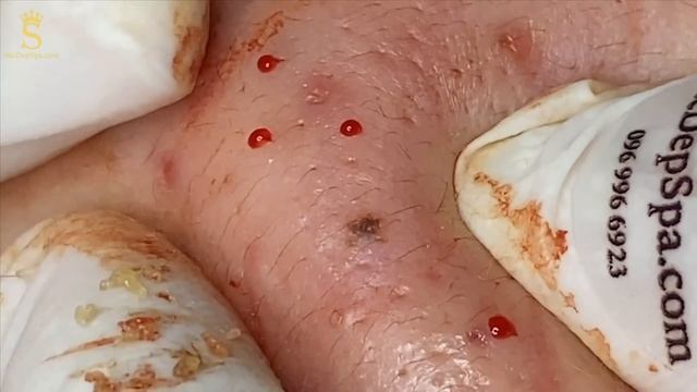 Гематомные прыщи (кровяные кисты) на щеках и лбу. #гематомныепрыщи #тяжелыйакне #лечениеакне смотреть онлайн