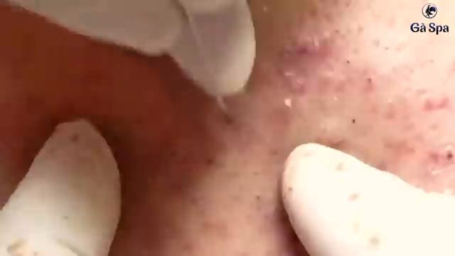 Лечение черных точек на левой щеке. #черныеточки #лечениеакне смотреть онлайн