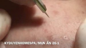 Лечение подкожных прыщей, готовых к воспалению. #подкожныепрыщи #лечениеакне #глубокиевоспаления