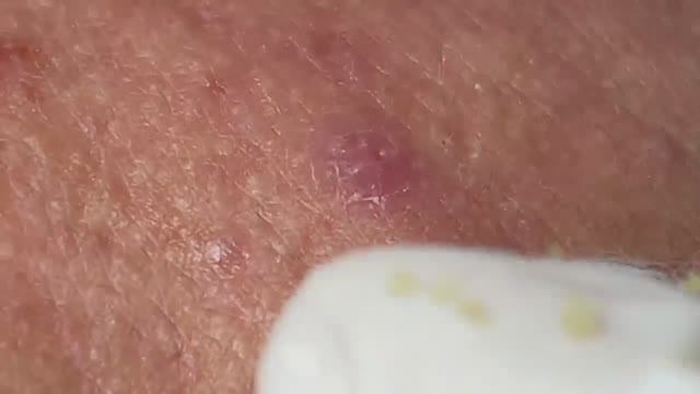 Огромные черные точки, скрытые глубоко под кожей. #удалениекомедонов #чисткалица #проблемнаякожа смотреть онлайн