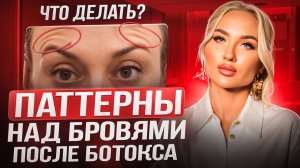 Паттерны над бровями после ботокса. Что делать?