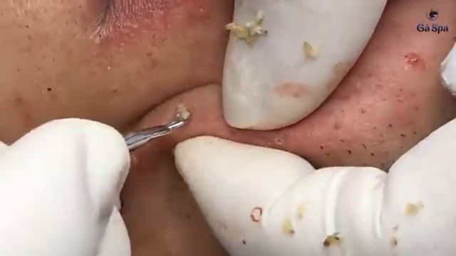 Полное видео выдавливания черных точек — Часть 3 смотреть онлайн