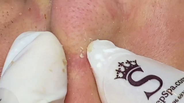 Белые и черные точки (комедоны): ПОЛНАЯ чистка и удаление! #черныеточки #белыеточки #комедоны смотреть онлайн