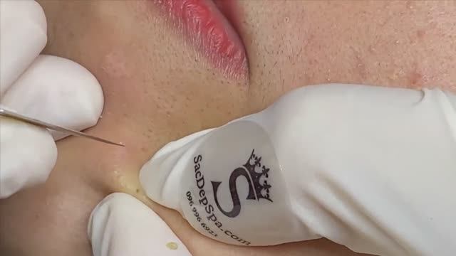 Белые угри (милиумы), черные точки (комедоны), закупоренные поры. #прыщи #угри #удалениепрыщей смотреть онлайн