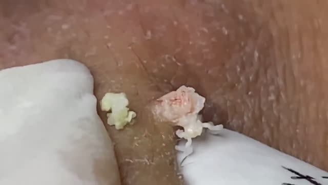 ASMR с подсветкой: чистка пор под увеличением. 2153 #комедоны #проблемнаякожа #уходзалицом смотреть онлайн