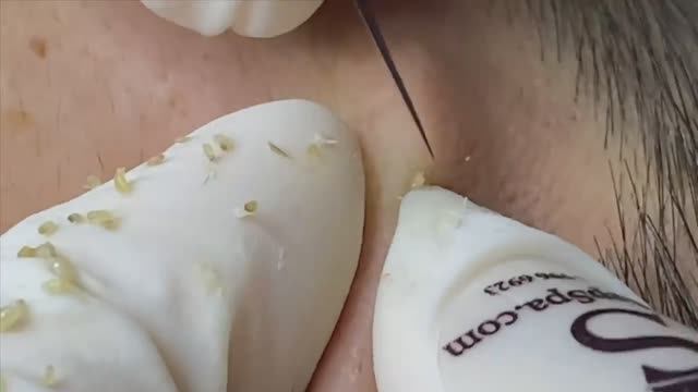 Удаление прыщей (акне) для мужчин #акне #постакне #механическаячистка смотреть онлайн