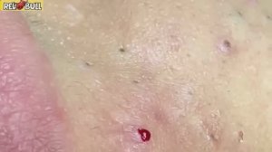 Глубокое очищение кожи. Успокаивающая косметическая процедура для снятия стресса  #𝟗𝟎𝟎𝟑𝟓𝟒