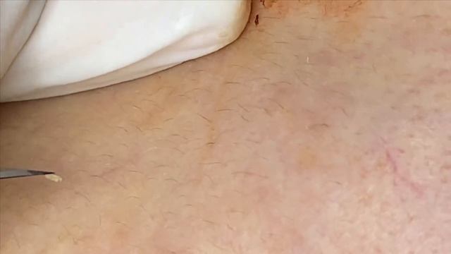 Прыщи (акне), скрывающиеся под кожей из-за регулярного макияжа. #прыщи #угри #угреваясыпь смотреть онлайн