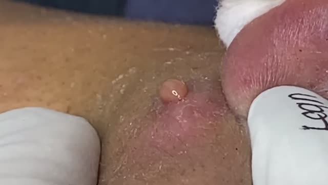 Чистка кожи с угрями. Осторожная работа. 2140 #прыщи #угри #угреваясыпь #удалениепрыщей смотреть онлайн