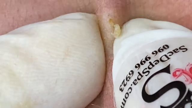 Чистка кожи от прыщей, камедонов и черных точек #1 смотреть онлайн