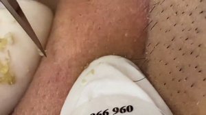 Чистка кожи от прыщей, камедонов и черных точек #2