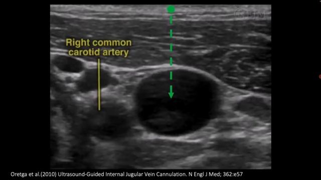 Установка катетеров в вену, под контролем УЗИ (рама) лекция для врачей УЗИ