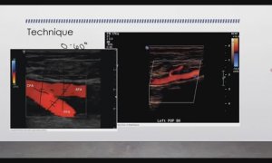 УЗИ артерии нижних конечностей (рама) Лекция для врачей