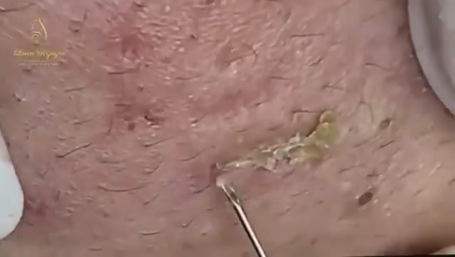 Удаление прыщей, которые мешали годами. 2148 #акне #постакне #механическаячистка смотреть онлайн