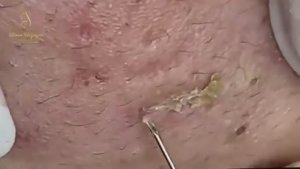 Удаление прыщей, которые мешали годами. 2148 #акне #постакне #механическаячистка