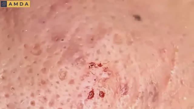 Чистка лица: профессиональная экстракция 2072. #комедоны #проблемнаякожа #уходзалицом смотреть онлайн