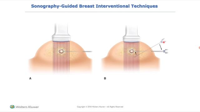 УЗИ грудных желез (рама) лекция для врачей