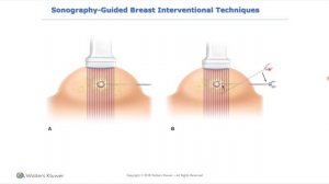 УЗИ грудных желез (рама) лекция для врачей