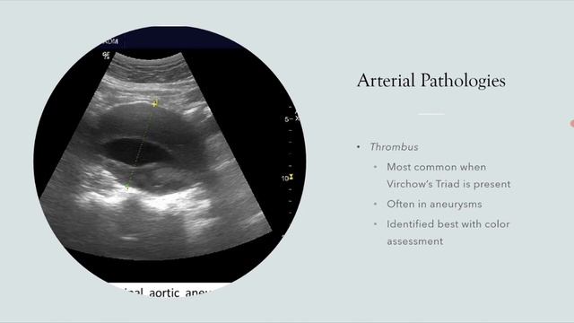 Сосудистые нарушения на УЗИ