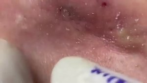 Идеальный финал: кожа после глубокой и качественной чистки. 2178