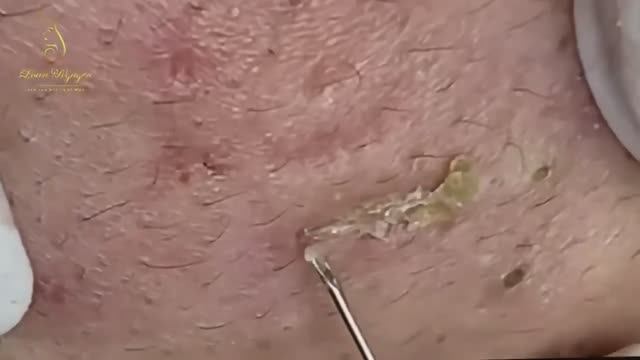 ASMR для сна: шепот и тихие звуки чистки. 2148 #черныеточки #чисткалица #прыщи #угри смотреть онлайн